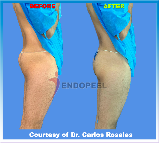 mature-man-right-profile-endopeel-gluteoplasty