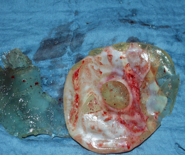 explosion gluteal implant