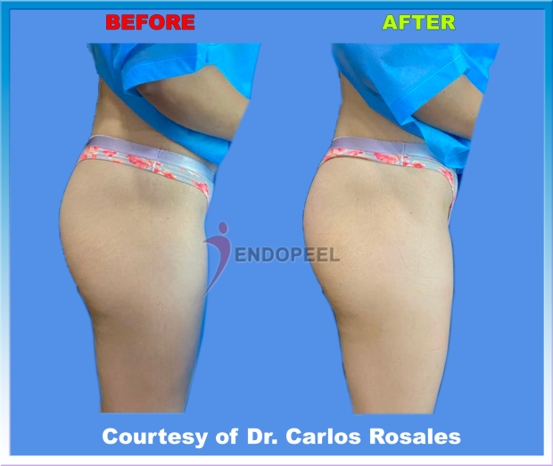 economic female gluteoplasty posterior view