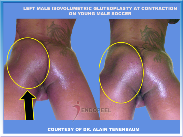 left male soccer gluteoplasty at contraction