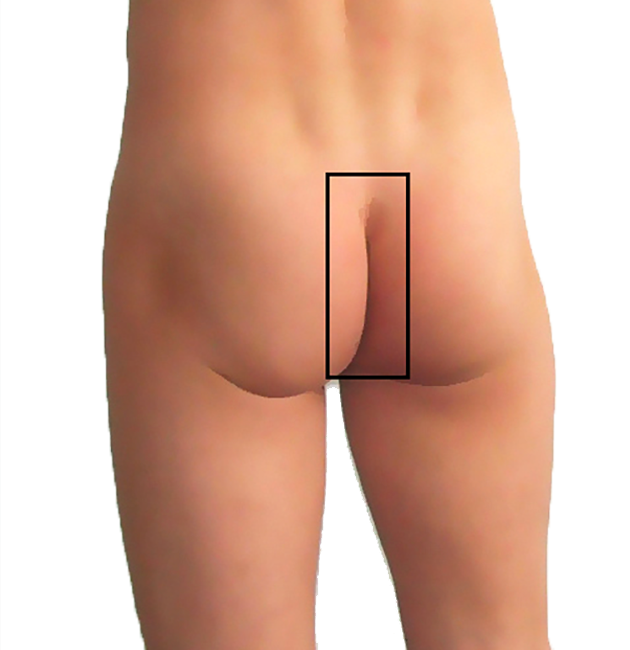 intergluteal-cleft