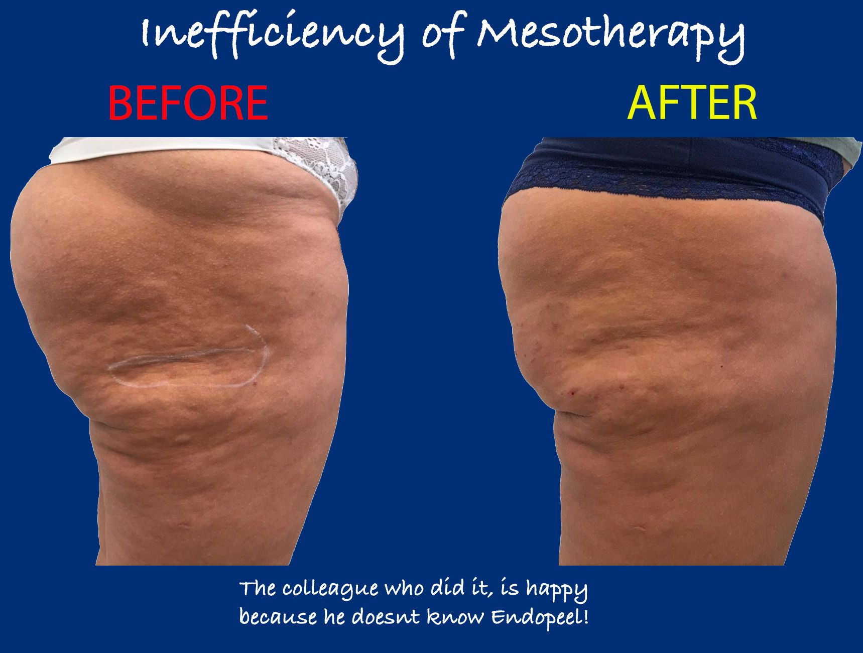 CELLULITE-MESOTERAPIA.jpg